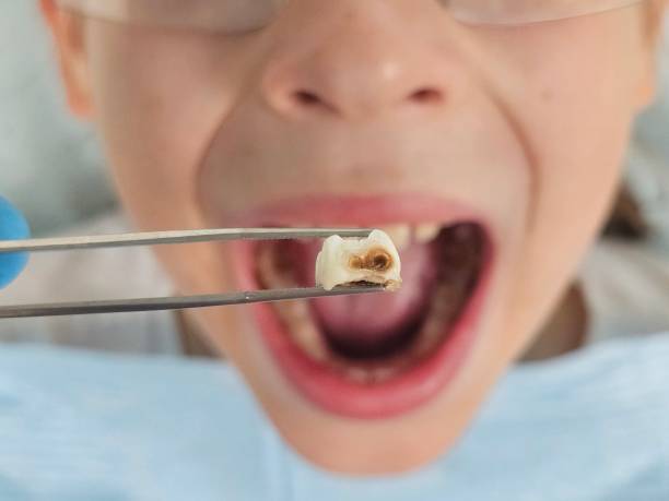 Best Chipped Tooth Repair Near Me  in Westfield, MA